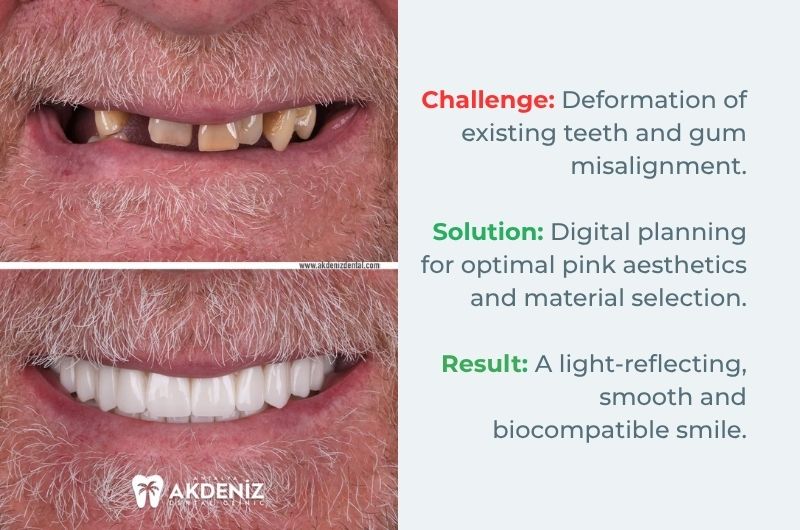 All on 4 dental implants before and after Turkey Antalya