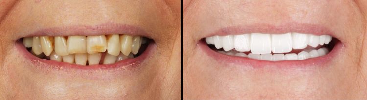 Zirconium Crowns Antalya before-after